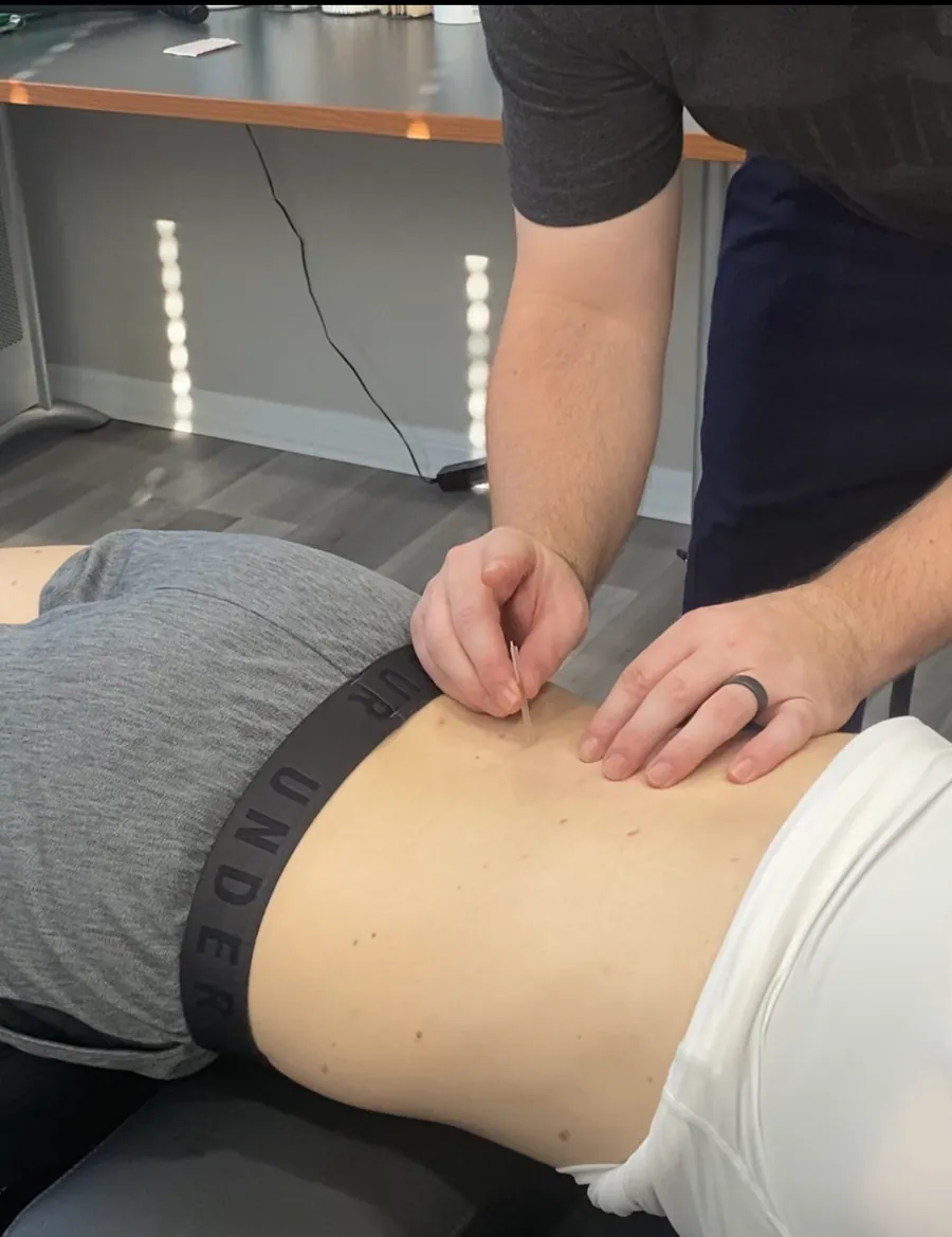Acupuncture at Catalyst Chiropractic and Rehab in Blaine, MN