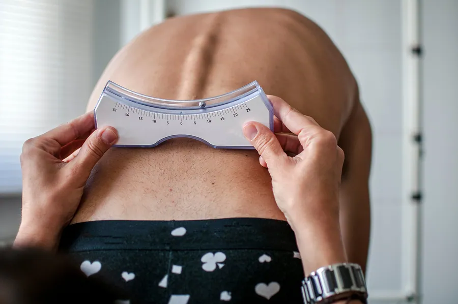 Scoliosis at Catalyst Chiropractic and Rehab in Blaine, MN