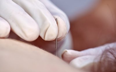 Health Benefits Of Acupuncture In Blaine MN